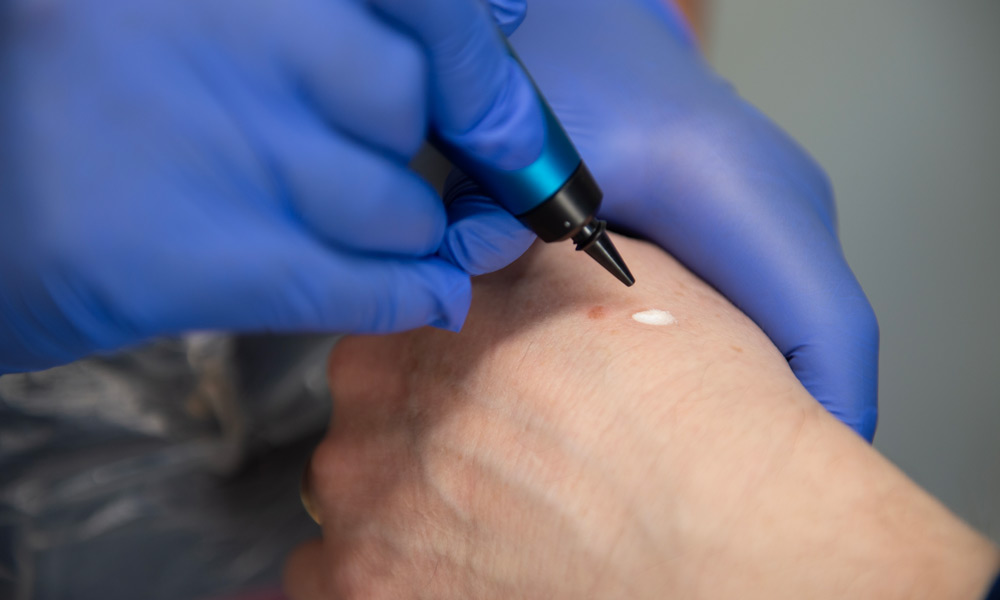 Cryo-therapy treatments